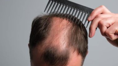 Kelliği olan bir adam saçını tarar. Saç dökülmesi sorunu olan bir adam. Gri arka planda alopesisi olan genç bir adamın yakın çekimi..