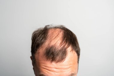 Gri bir arka planda genç bir adamın kelleşen kafası..