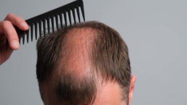 Kelliği olan bir adam saçını tarar. Saç dökülmesi sorunu olan bir adam. Gri arka planda alopesisi olan genç bir adamın yakın çekimi..
