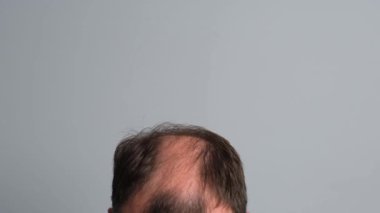 Saç dökülmesi sorunu olan bir adam. Gri arka planda alopesisi olan genç bir adamın yakın çekimi..