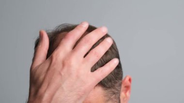 Saç dökülmesi sorunu olan bir adam. Gri arka planda alopesisi olan genç bir adamın yakın çekimi..