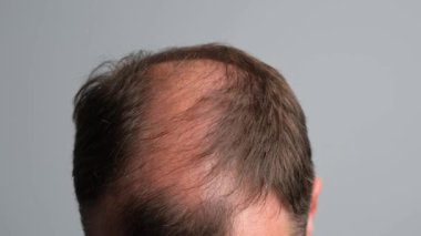 Kelliği olan bir adam saçını tarar. Saç dökülmesi sorunu olan bir adam. Gri arka planda alopesisi olan genç bir adamın yakın çekimi..