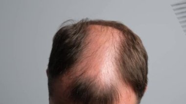 Kelliği olan bir adam saçını tarar. Saç dökülmesi sorunu olan bir adam. Gri arka planda alopesisi olan genç bir adamın yakın çekimi..