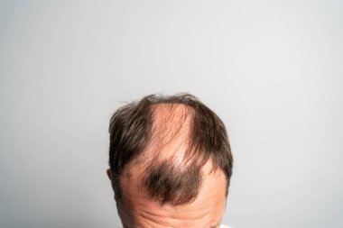 Gri bir arka planda genç bir adamın kelleşen kafası..