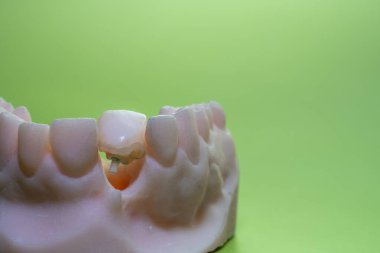 Canlı yeşil bir arka planda yumuşak pembe bir kalıptaki tek bir diş implantının detaylı görüntüsünü gösteren bir diş kalıbı. Kompozisyon, gerçekçi ışıklandırma ile diş protezine odaklanıyor.