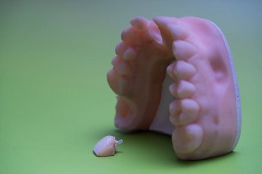 Diş kalıbı, üst çene kalıbının altına ön diş implantı yerleştirildiğini gösteriyor. Görüntünün yeşil bir arka planı var, diş işçiliğinin detaylarını vurguluyor