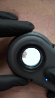 Dermatoskopi, ben kontrolü, cilt muayenesi, dermatoskop, melanom tespiti, makro deri görünümü.