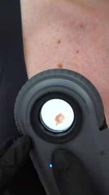 Dermatoskopi, ben kontrolü, cilt muayenesi, dermatoskop, melanom tespiti, makro deri görünümü.