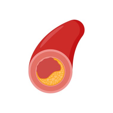 Vektör olarak Atherosclerosis simgesi. Logotype