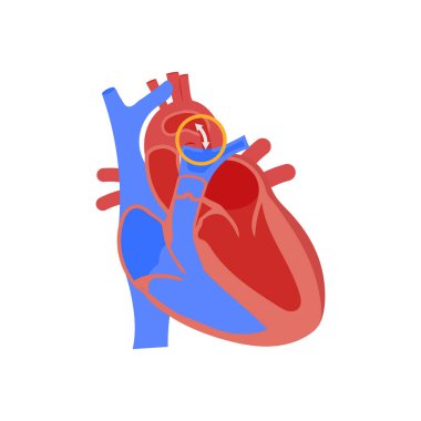 Patent Ductus Arteriosus simgesi vektörde. Logotype
