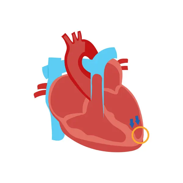 Vektör içinde genişlemiş kardiyomiyopati simgesi. Logotype