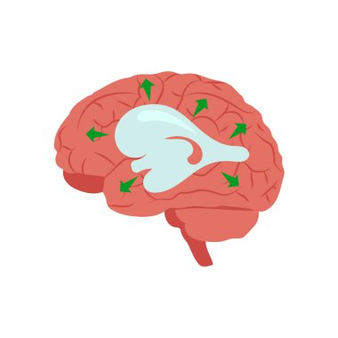 Hidrosefalus Düz Vektör Resimleri İzole Edildi