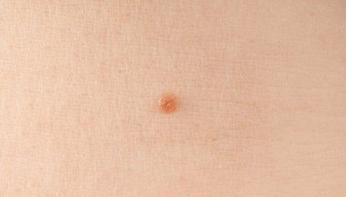 Deri benini yakından çek. İnsan doğum lekesi, iyi huylu nevus veya köstebek makro dokusu, potansiyel melanom veya dermatoloji tasarımı için kanser