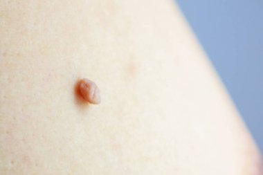 İnsan derisinde Papiloma neoplazmasının doğum lekesi