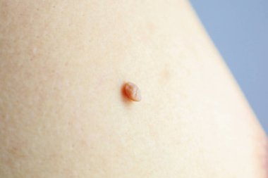 Büyük papilloma ve koltuk altında bir ben var. İnsan Papilloma Virüsü.