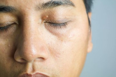 Göz kapaklarında Xanthelasma var.