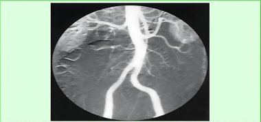 Monochrome contrast-enhanced angiographic image focusing on the abdominal aorta and its branching arteries, providing detailed visualization for vascular diagnostic purposes. clipart