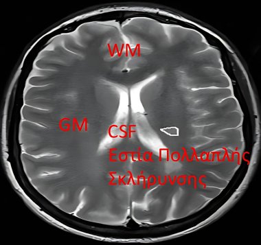 High-resolution brain MRI scan displaying detailed gray matter, white matter, cerebrospinal fluid (CSF), and a highlighted multiple sclerosis lesion for advanced diagnostic and research purposes clipart