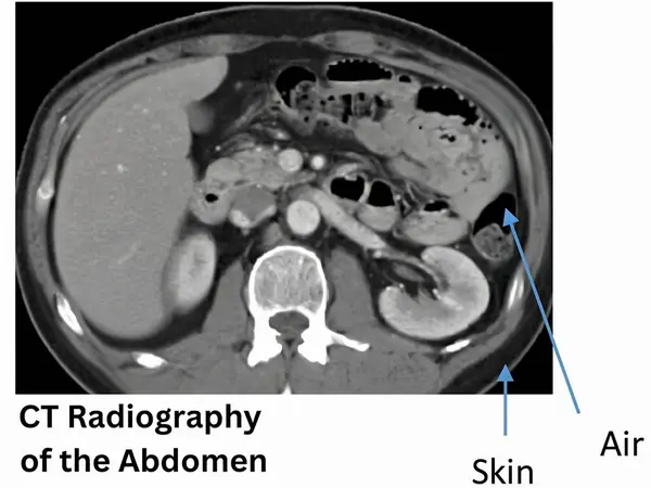 Karın iç anatomik yapıları ve hava farklılıklarını gösteren bir CT radyografisi, karın durumları için teşhis ve tedavi planlamasına yardımcı olur..