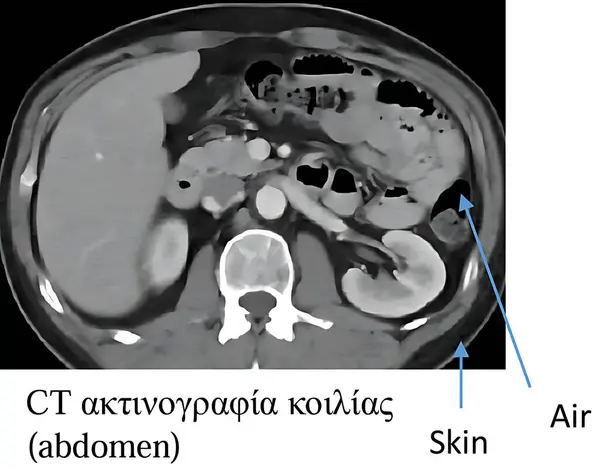 Bu yüksek çözünürlüklü CT taraması, deri ve hava bölgelerinin temiz etiketlenmesiyle karın bölgesinin çapraz görüntüsünü gösteriyor. Anormallikleri tanımlamak ve klinik teşhisleri desteklemek için kullanışlı