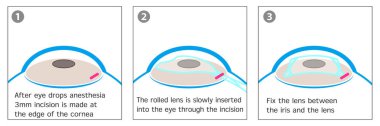 ICL (takılabilir lens) ameliyatının ana prosedürlerini gösteren net, üç adımlı bir diyagram. Görme düzeltmesi veya göz tedavisi hakkında eğitici materyaller için ideal.