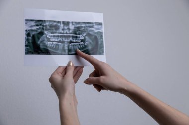Bir birey diş röntgeni tutuyor ve diş durumlarını veya tedavi planlarını analiz etmek için görüntüdeki belirli diş bölgelerine işaret ediyor. Odak noktası oral sağlık kontrolleri..