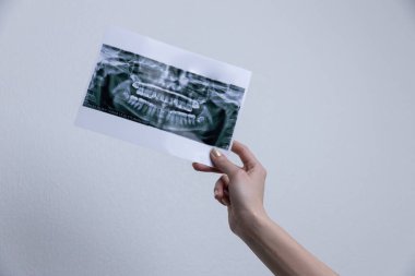 Bir birey diş ve çene yapısını net bir şekilde gösteren bir diş röntgeni tutuyor, teşhis, tedavi planlaması ve diş hekimliğinde ağız sağlığı değerlendirmeleri için hayati önem taşıyor.