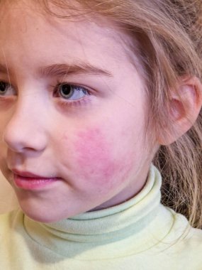 Kızarık Yanaklı Bir Kızın Yakın Çekimi.