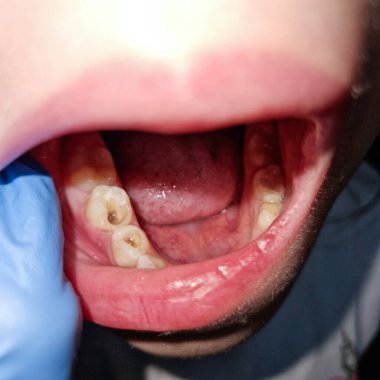 Diş kök kanal tedavisinden sonra bir çocuğun azı dişlerinin yakın çekimi, temiz çürükleri gösterir