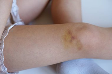 Dizinde çürük olan bir çocuğun bacağının yakın çekimi yaranın iyileşme sürecini gösteriyor.