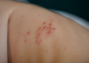Suçiçeği kızarıklığıyla kaplı bir çocuğun gövdesine yakın çekim. Bulaşıcı hastalıklar sırasında cilt hastalığının ayrıntılı görünümü. Konsept: Tıbbi semptomlar, bulaşıcı hastalık, dermatolojik sorun, çocuk sağlığı endişesi.