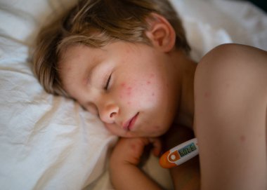 Suçiçeği isiliği olan hasta bir çocuk termometreyle uyuyor. Hastalık sırasında ateşi olan çocuğun yakın çekimi. Konsept: çocukluk hastalığı, ebeveynlik bakımı, dinlenme ve iyileşme, ateş ve yorgunluk..