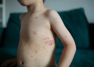 Çocuk gövdesi suçiçeği kızarıklığıyla kaplı. Cildi varisella virüsü yüzünden kaşınıyor. Pediatrik bulaşıcı hastalık belirtileri. Yüksek kalite fotoğraf