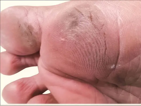 nasırlı ayak ya da ölü deri