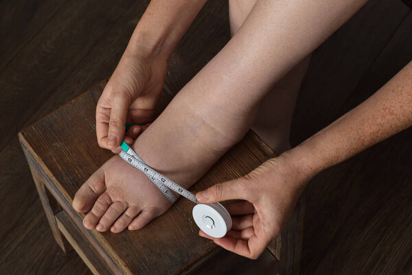 Woman measuring foot affected by lymphedema condition with tape measure