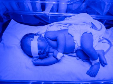 Fototerapi lambası altında yeni doğmuş bir oğlan..