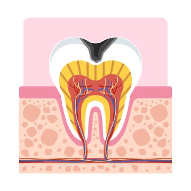 Diş çürüğü kesiti diş sağlığı eğitimi için diş minesi, dentin ve pullardaki çürük hasarını gösteriyor ve beyaz arka planda izole edilmiş..