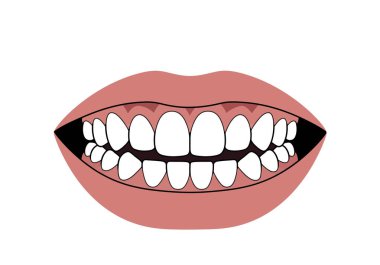 Diş klipsli ağız. Bu görüntü, hem üst hem de alt dişleri olan, gülümseyen bir ağzı gösteriyor. Çizim tasarımı.