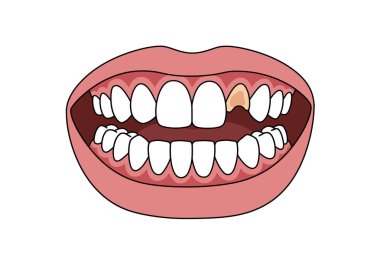 Gevşek diş klipsleri. Bu resim açık bir ağız ve sarılı gevşek bir diş gösteriyor. Çizim tasarımı.