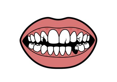 Kırık diş klipsi sanatı. Bu resim, kırık ve çürük dişli bir ağız gösteriyor. Çizim tasarımı.