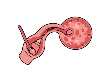 Vazektomi sanatı. Bu görüntü vazektomi ameliyatının tıbbi bir örneğini gösteriyor. Çizim tasarımı.