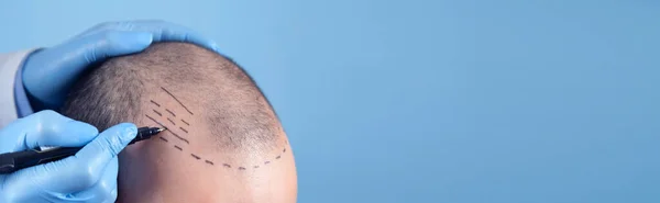 Bir doktorla görüşürken saç dökülmesinden muzdarip bir hasta. Metnin için boşluk