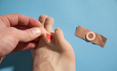 Ayakta nasır var. Cilt sorunları