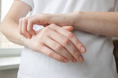 Aşırı kuraklık, rahatsızlık ve kaşıntıdan muzdarip ellerin yakın çekimi. Kuru cilt problemi, kış cilt hasarı