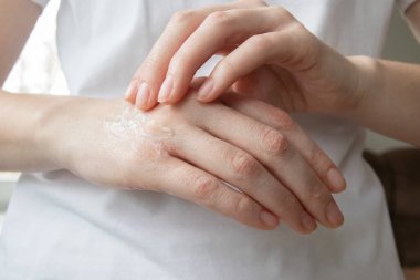 Kuru eline nemlendirici krem süren bir kadın. Çatlak, susuz kalmış, kronik kuru deri..