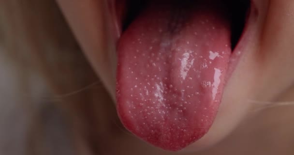 Kızıl Saçlı Kız Sivilcelerle Kaplı Kırmızı Bir Dil Gösteriyor Hastalık — Stok video