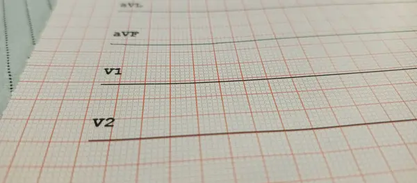 Tıbbi grafik kağıdında düz çizgi ölçümlerini gösteren bir ECG çıktısının yakın çekimi. Görüntü V1 ve V2 ipuçlarını vurguluyor, genelde kalp izleme ve teşhiste kullanılır. Sağlık, kardiyoloji ve acil tıp görselleri için ideal.
