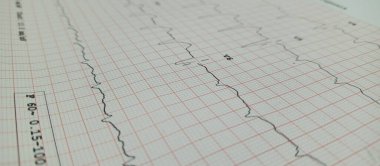Elektrokardiyogram (ECG) kaydının yakından görüntüsü, ızgara kağıdında kalp dalgalarını gösteriyor. Kurşun V6 görünür, PQRST kompleksleri temiz. EKG bandı kalp rahatsızlıklarını teşhis etmek, kalp ritmini izlemek için kullanılır., 