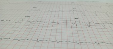 Standart bir şebeke kağıdında kalp ritmini gösteren elektrokardiyogramın (ECG) yakın çekimi. AVF ve V3 elektrokardiyogram uçlarında belirgin kardiyak aktivite ya da anormallikleri gösteren farklı dalga formları görülüyor..