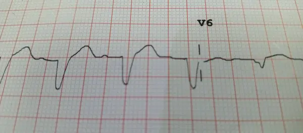 Tıbbi ortamlarda kalp izleme ve tanı için kullanılan kurşun V6 ile kalp ritmini gösteren bir elektrokardiyogramın (ECG) yakın çekimi.